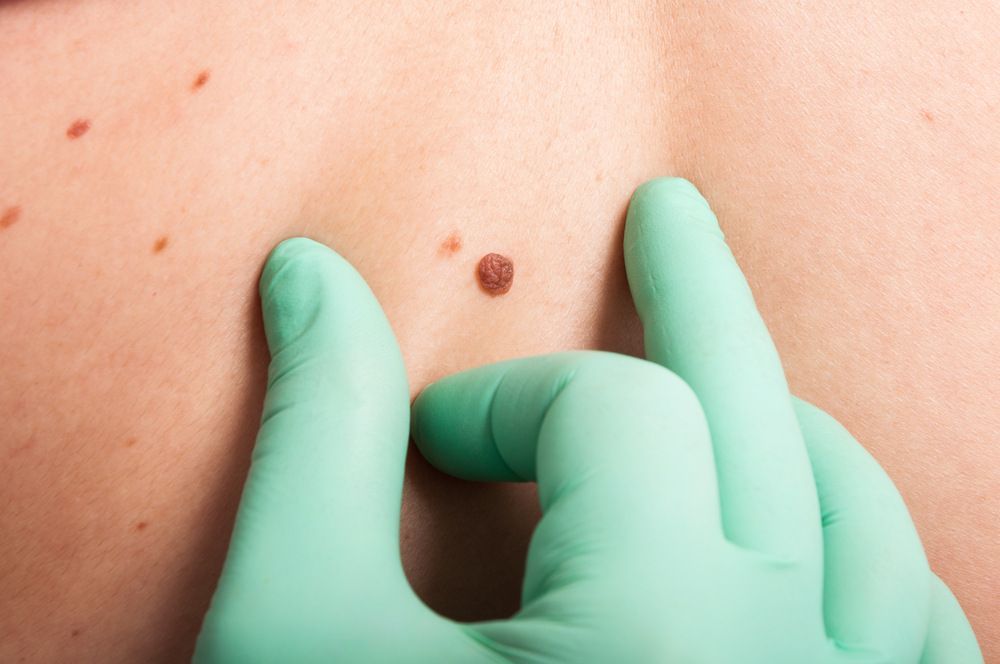 A Person Wearing Green Gloves is Examining a Mole — Coastal Skin & Laser in Mooloolaba, QLD