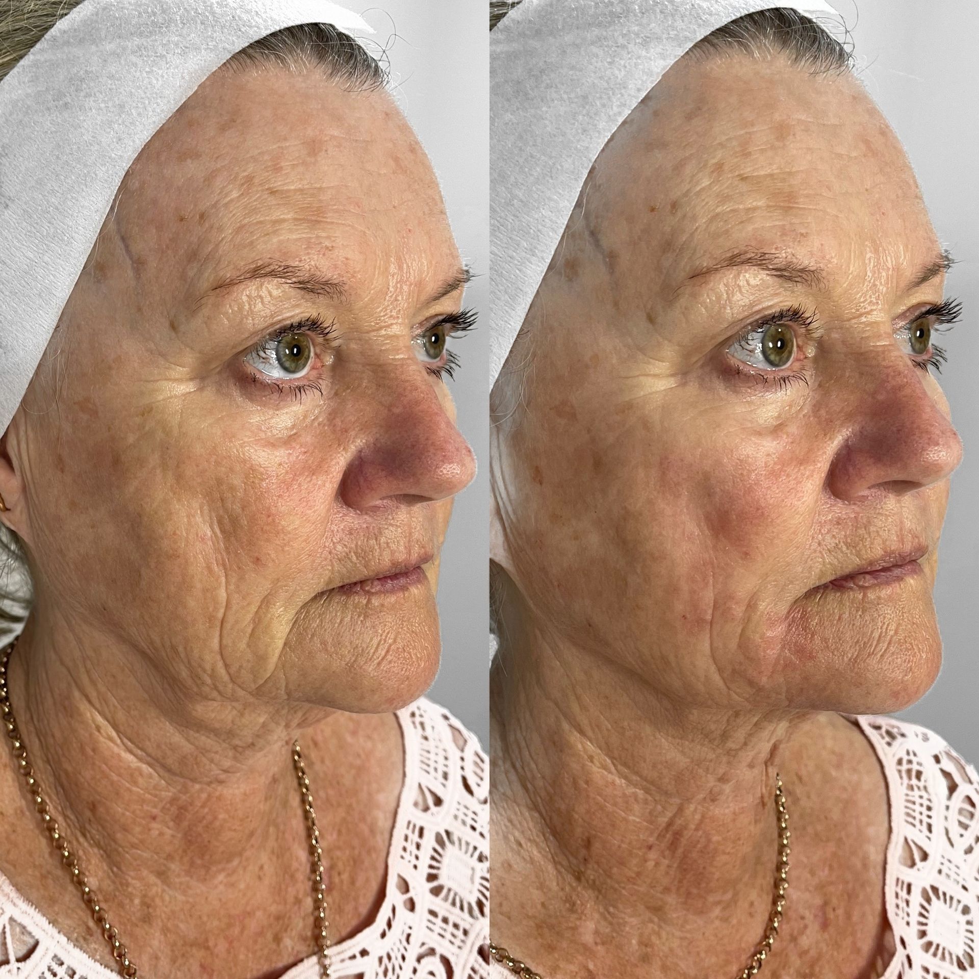 Before and After Laser Treatment of Woman