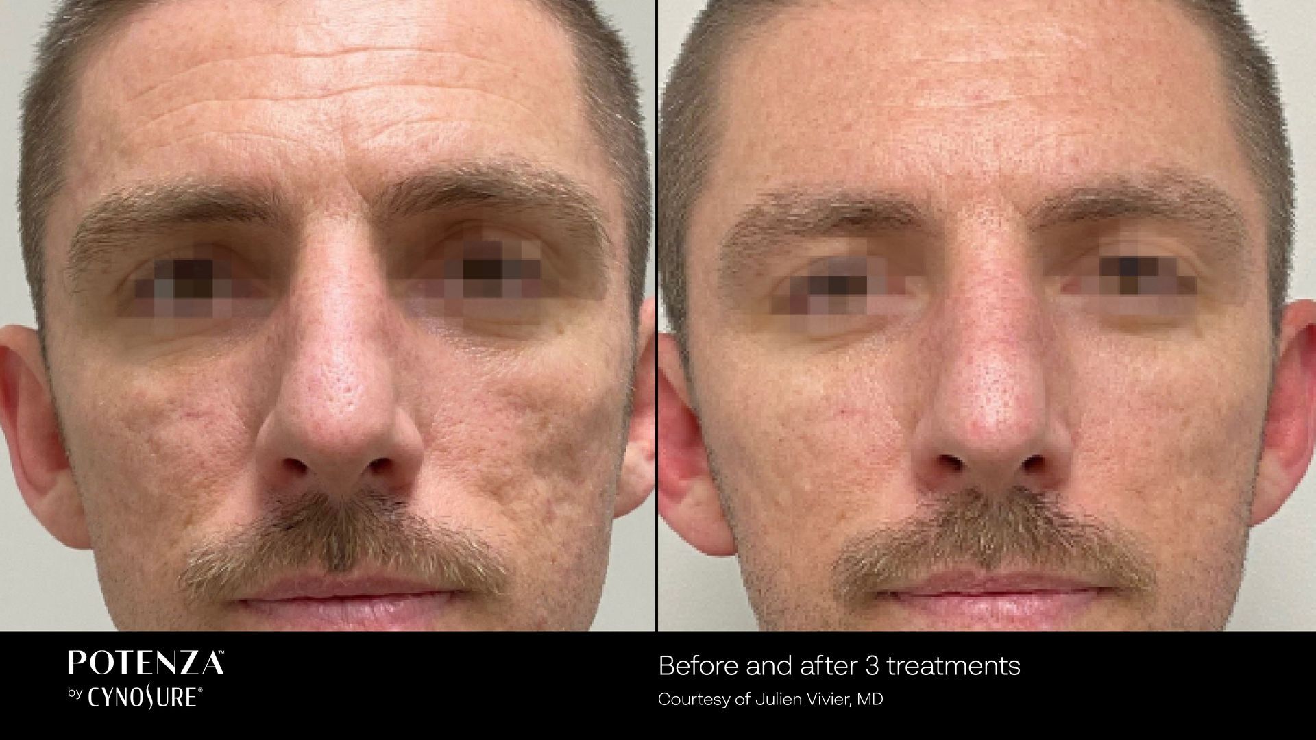 Before and after Potenza facial treatment. Male face with improved skin texture.