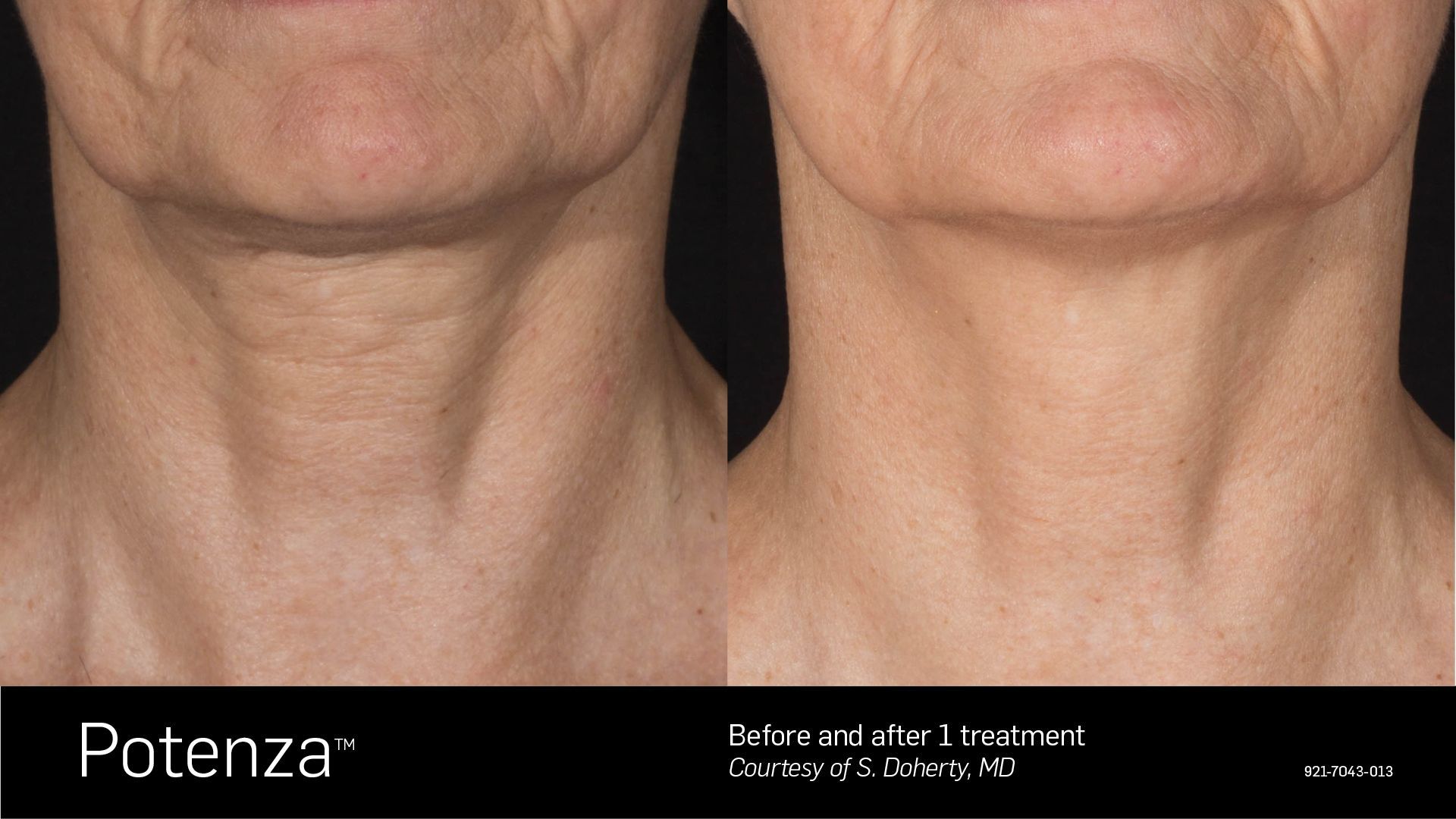 Before and after treatment of a neck. The “before” has wrinkles, the “after” is smoother.