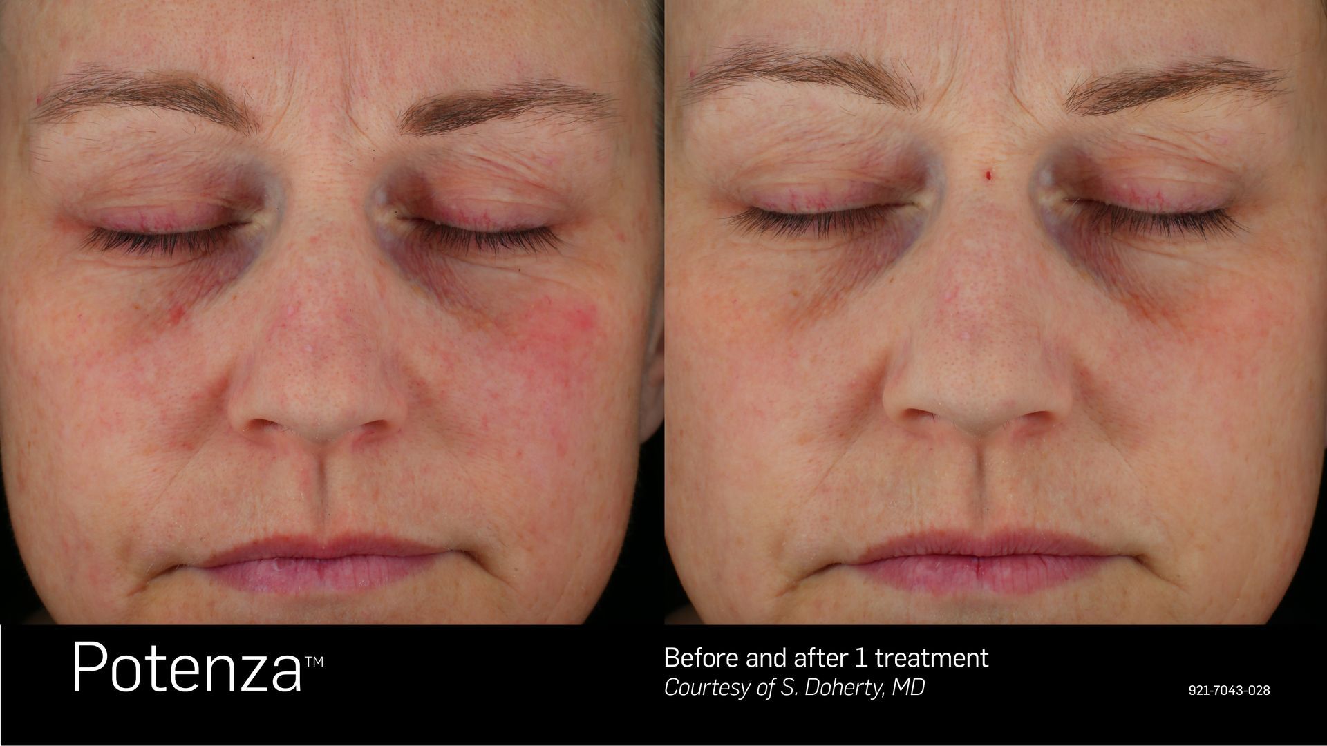Before and after Potenza skin treatment. Woman's face with wrinkles, redness on left cheek, smoother after treatment.