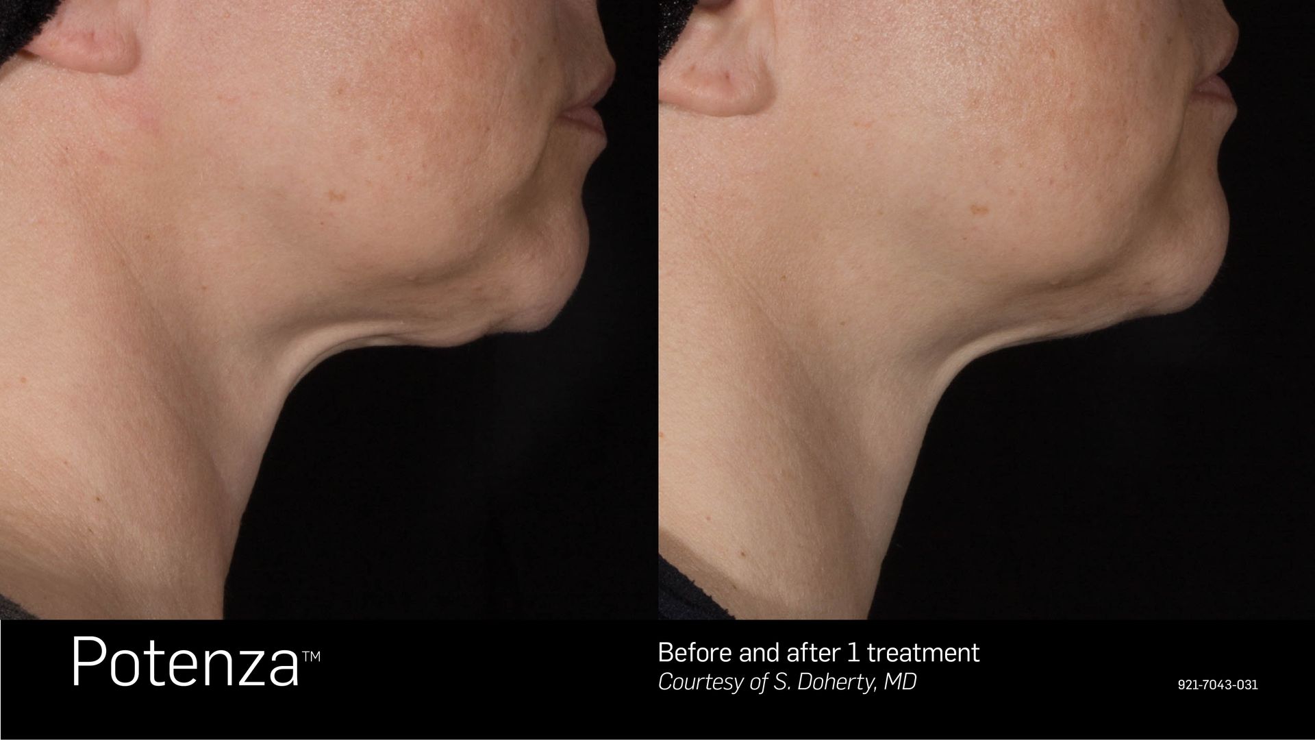 Before and after view of a person's neck and jawline after a Potenza treatment.