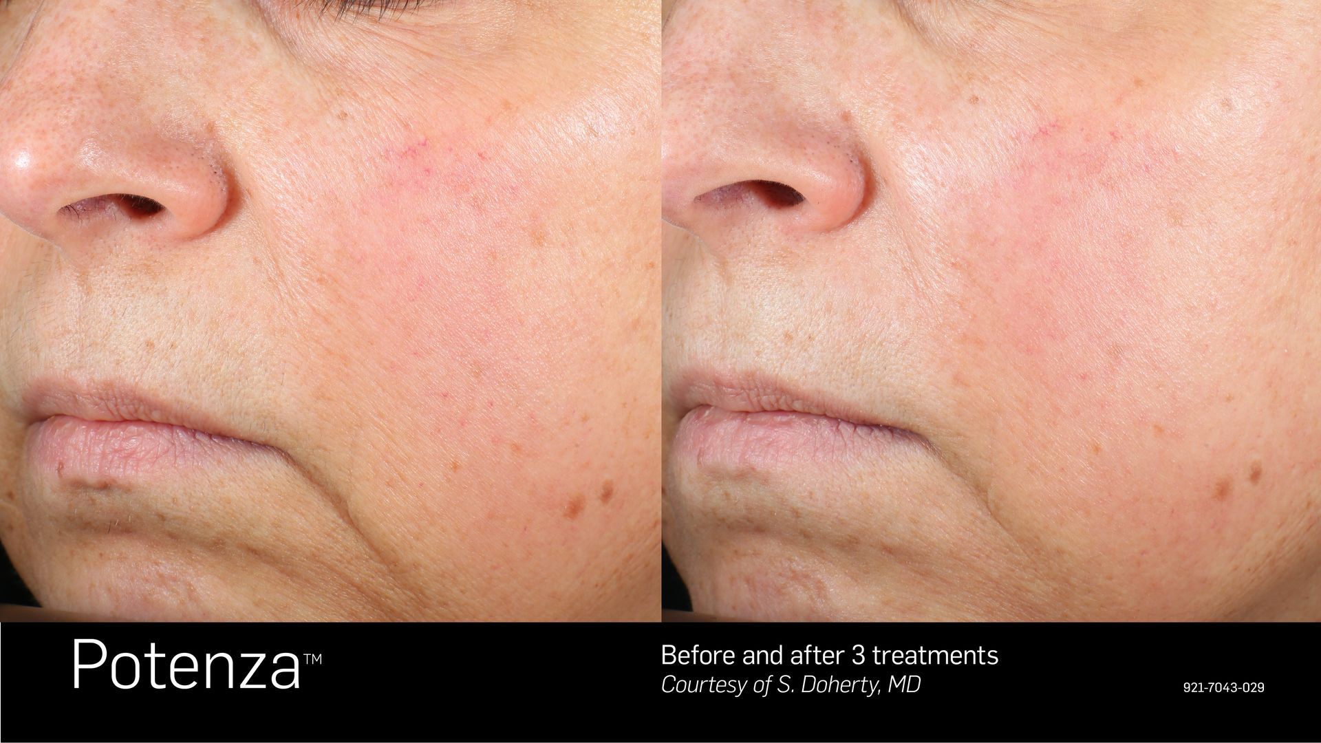 Before and after Potenza treatments: facial skin shows improvement in texture and wrinkles.
