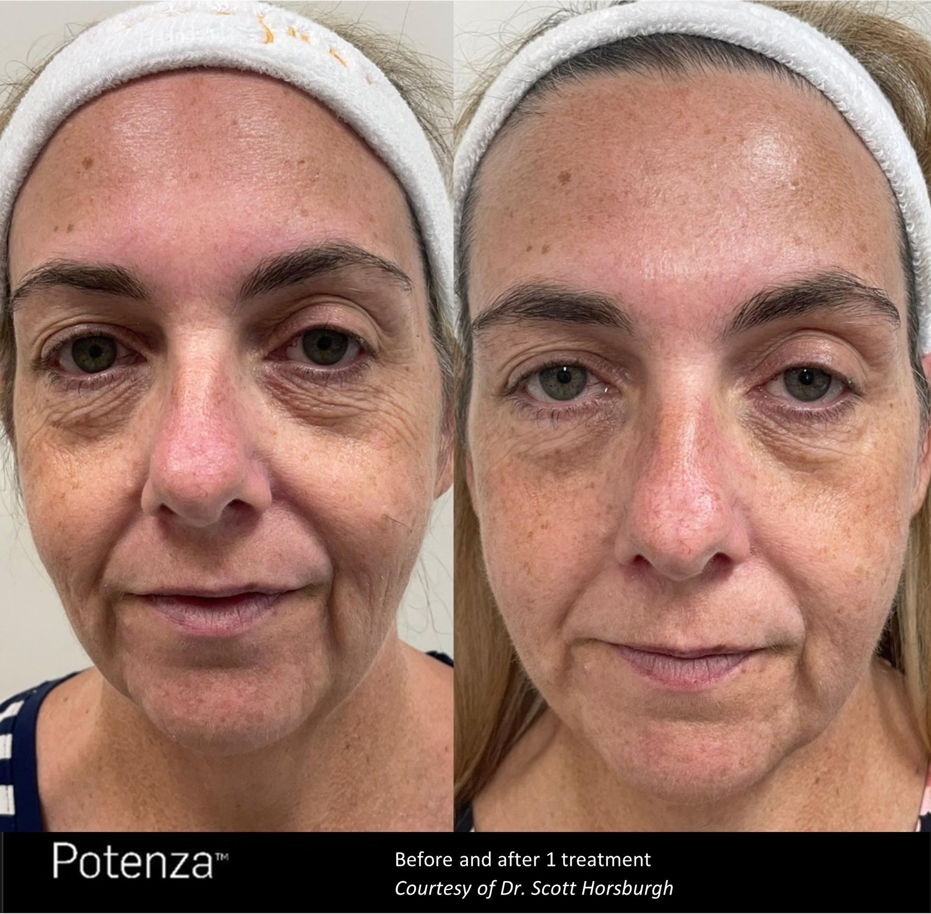 Before and after photos showing skin rejuvenation after Potenza treatment on a woman's face.