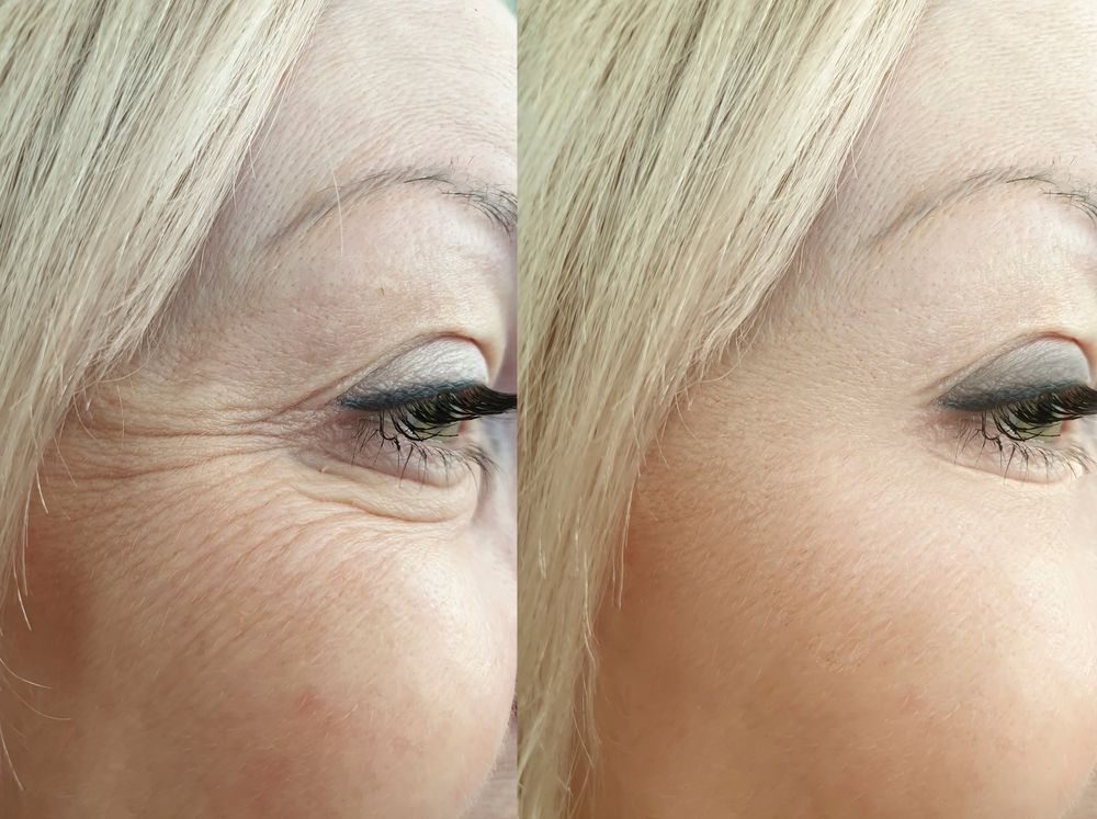 Two close-up Views of a Person's Eye Area: Before and After Apparent Wrinkle Reduction — Coastal Skin & Laser in Tewantin, QLD 