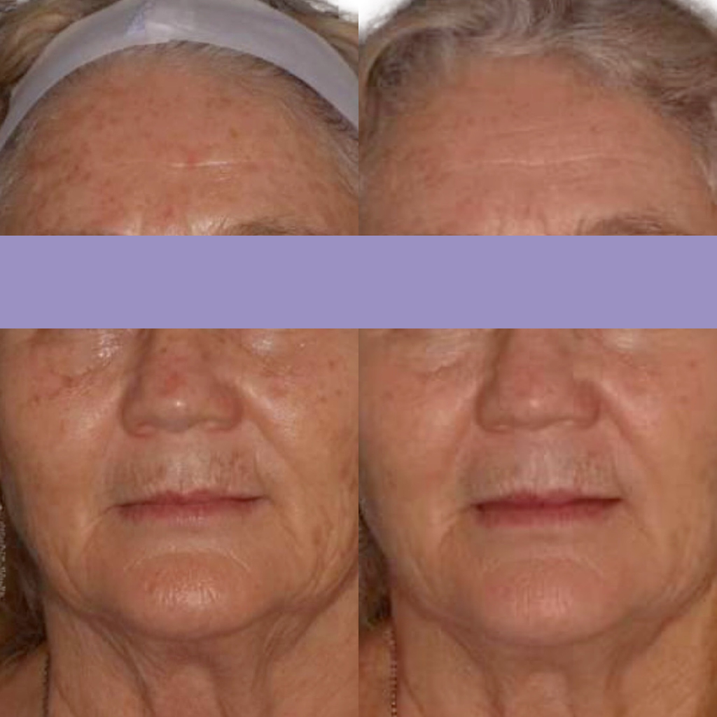 A Before and After Photo Showing a Woman Facial Transformation — Coastal Skin & Laser in Tewantin, QLD