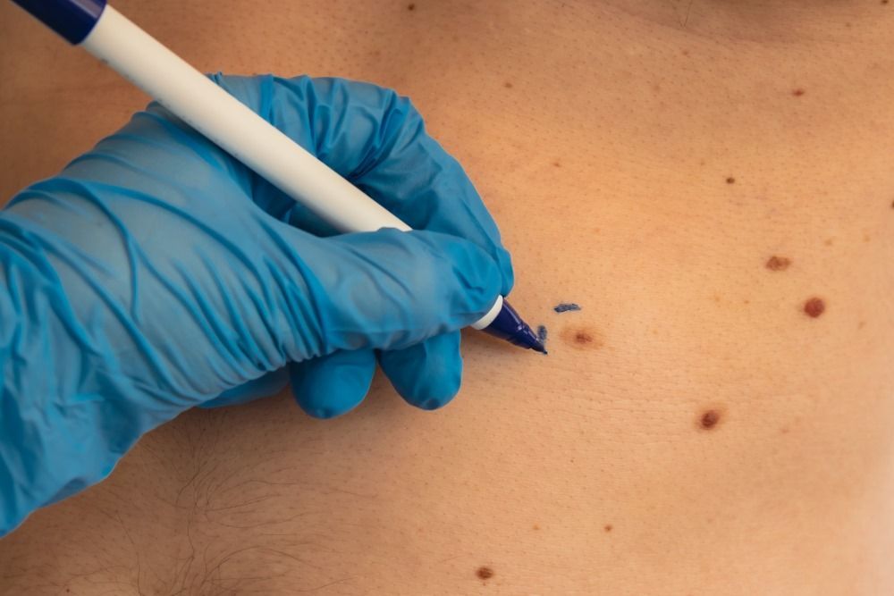 A Doctor is Writing on a Patient's Skin With a Marker — Coastal Skin & Laser in Tewantin, QLD