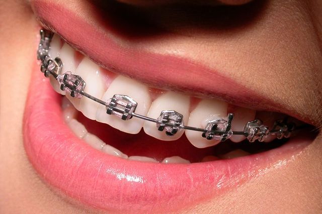 Orthodontic Treatment Process