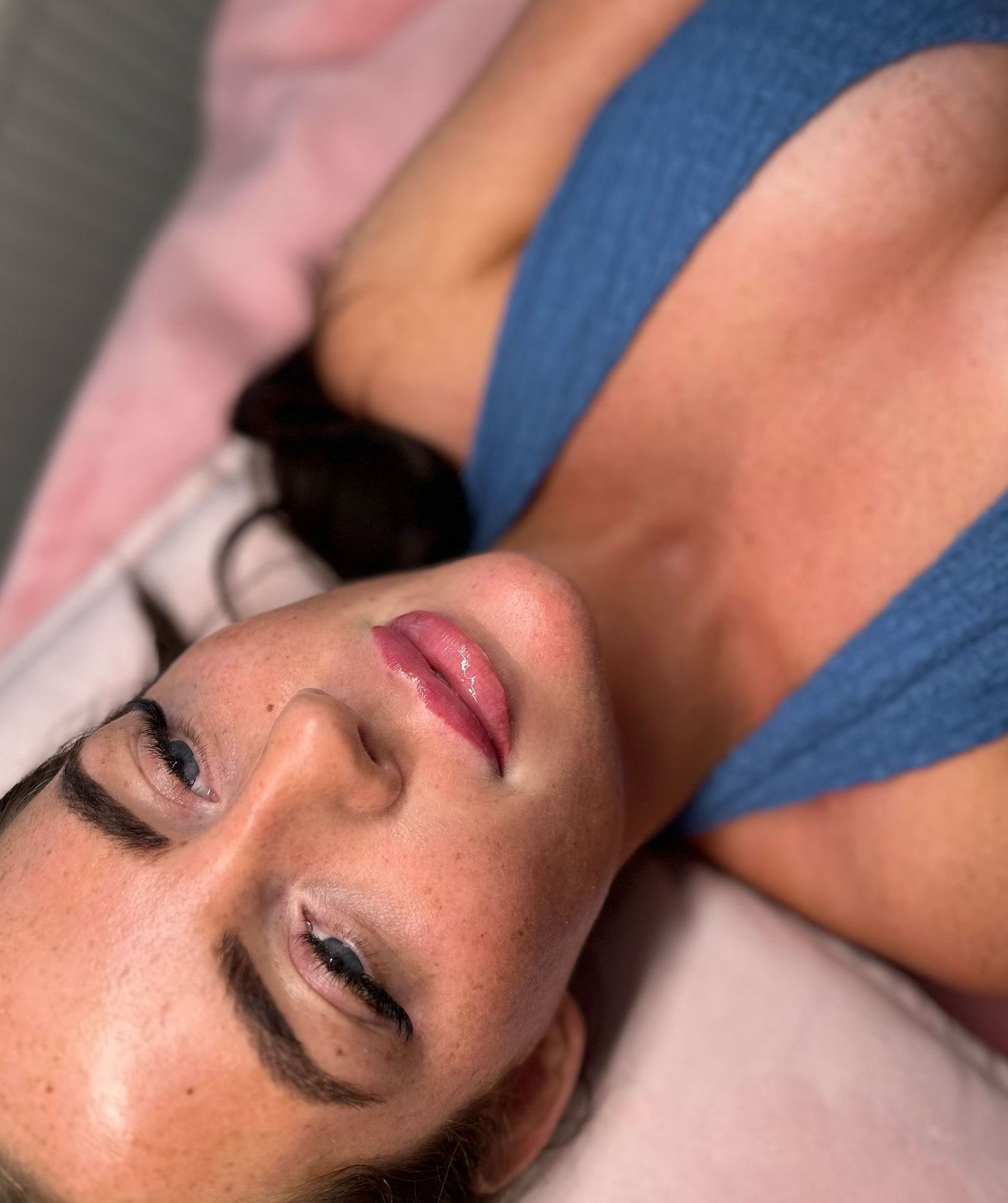 Lip filler in Southend-on-sea