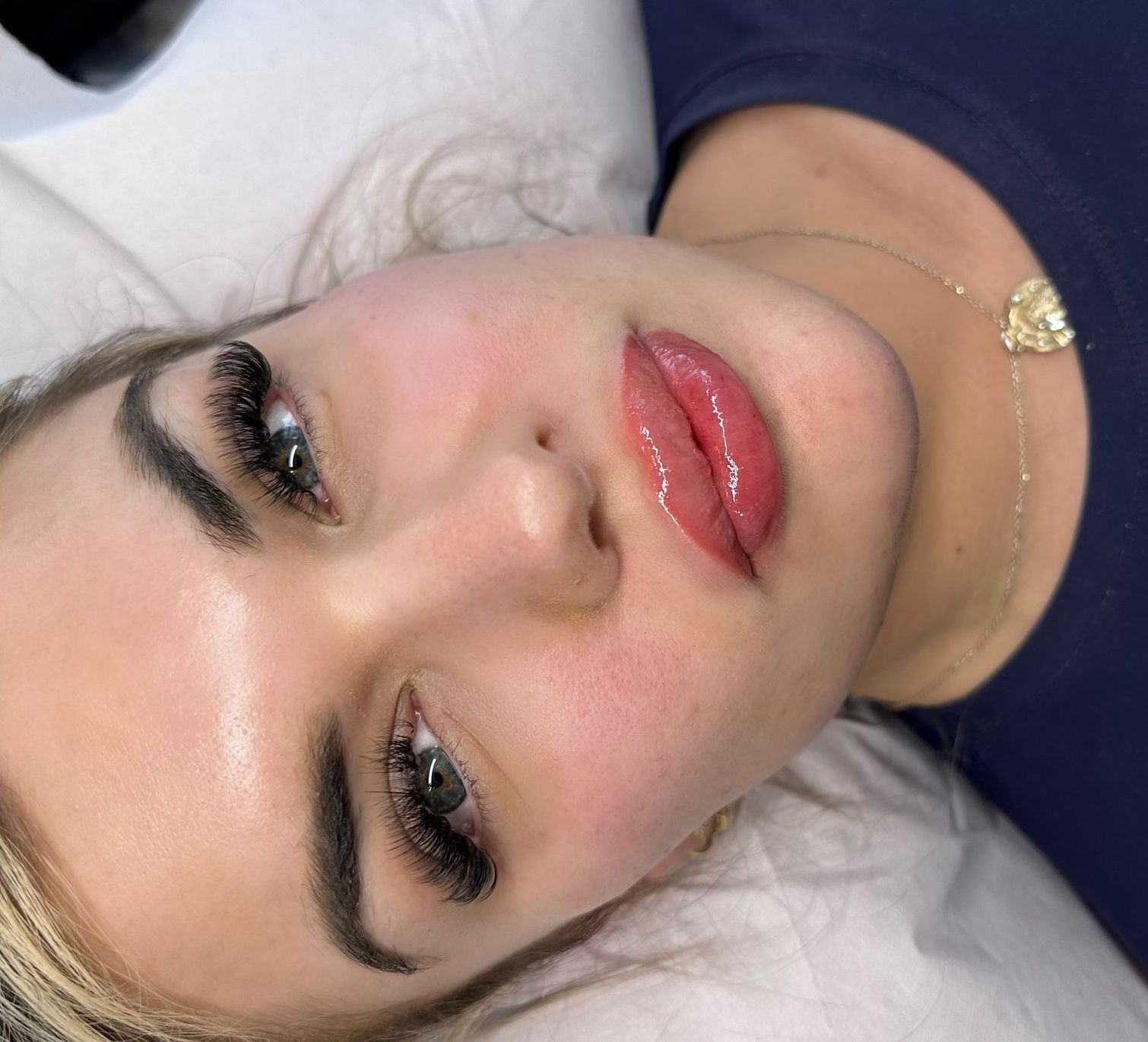 Lip filler and facial contour in Thorpe Bay, Essex