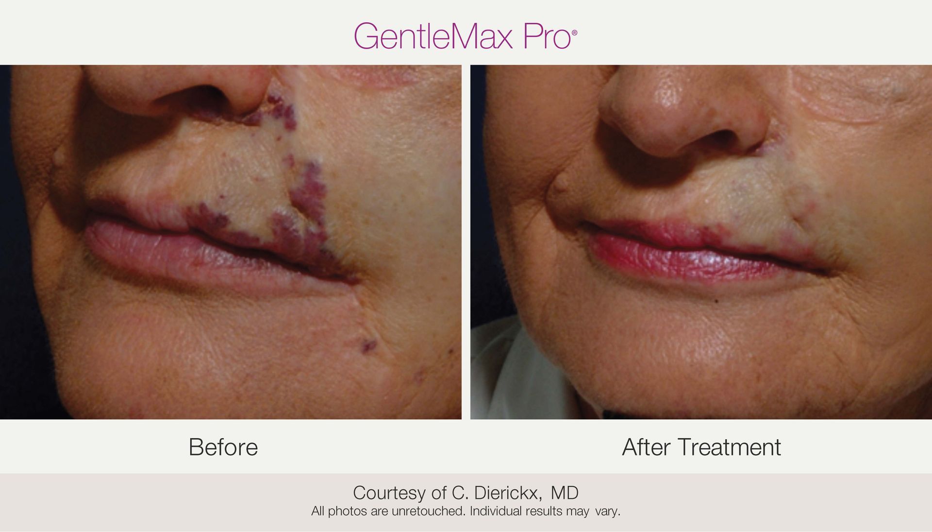 Before and after photos of a person's face with a port-wine stain on the lip, treated with a laser.