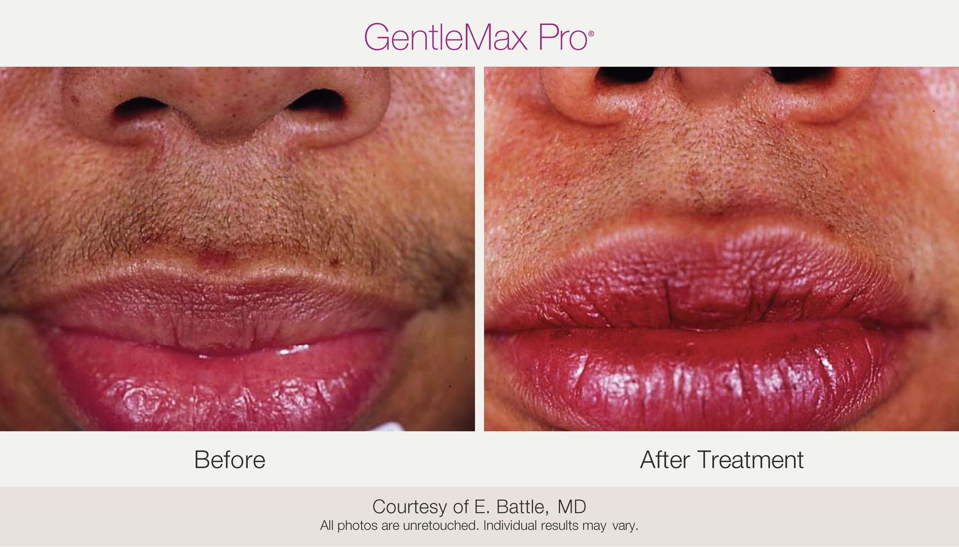 Before and after photos of a woman's upper lip, demonstrating hair removal using the GentleMax Pro laser.