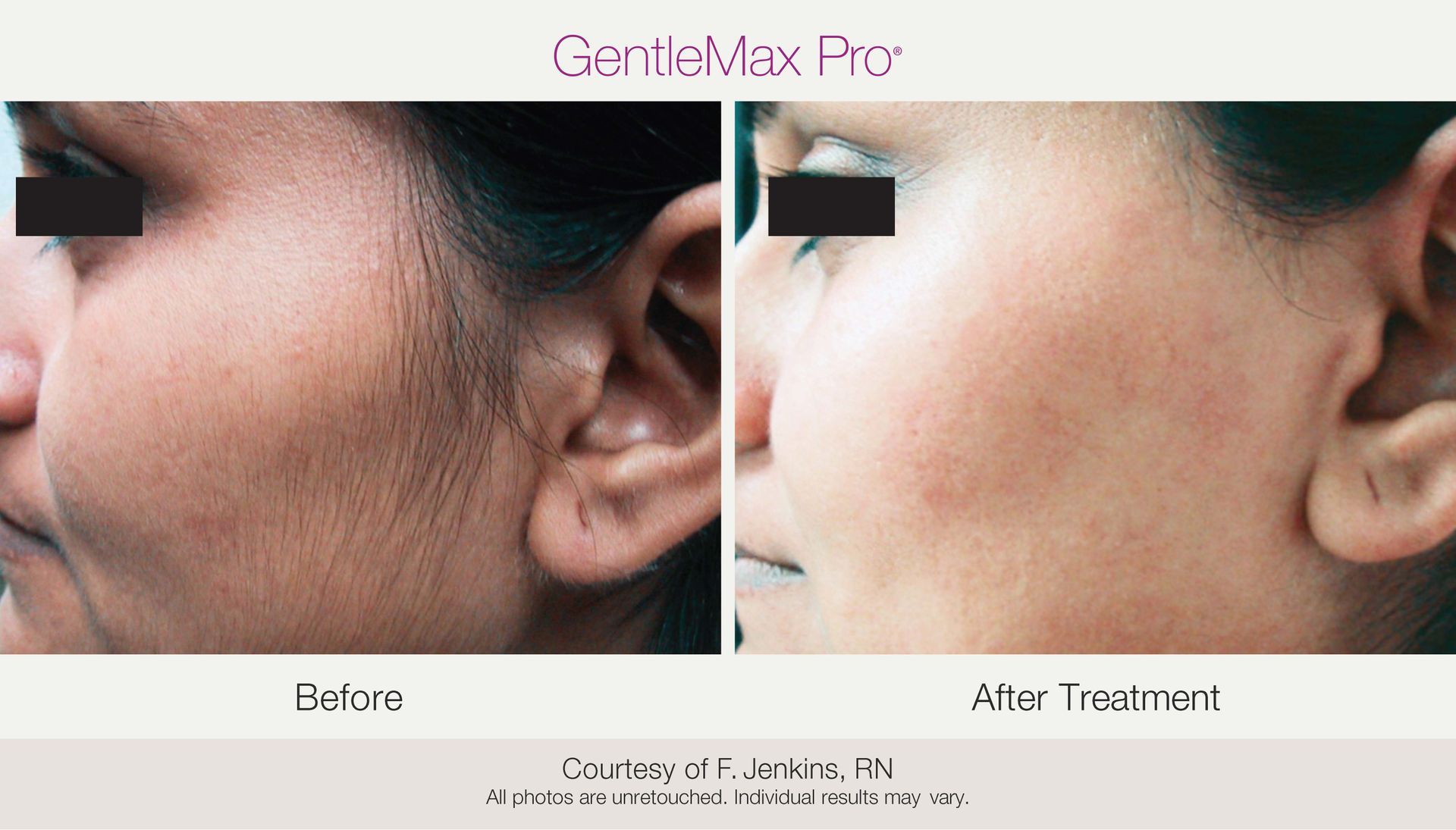 Before and after view of a woman's face. The left side shows excess facial hair, the right side after laser hair removal.