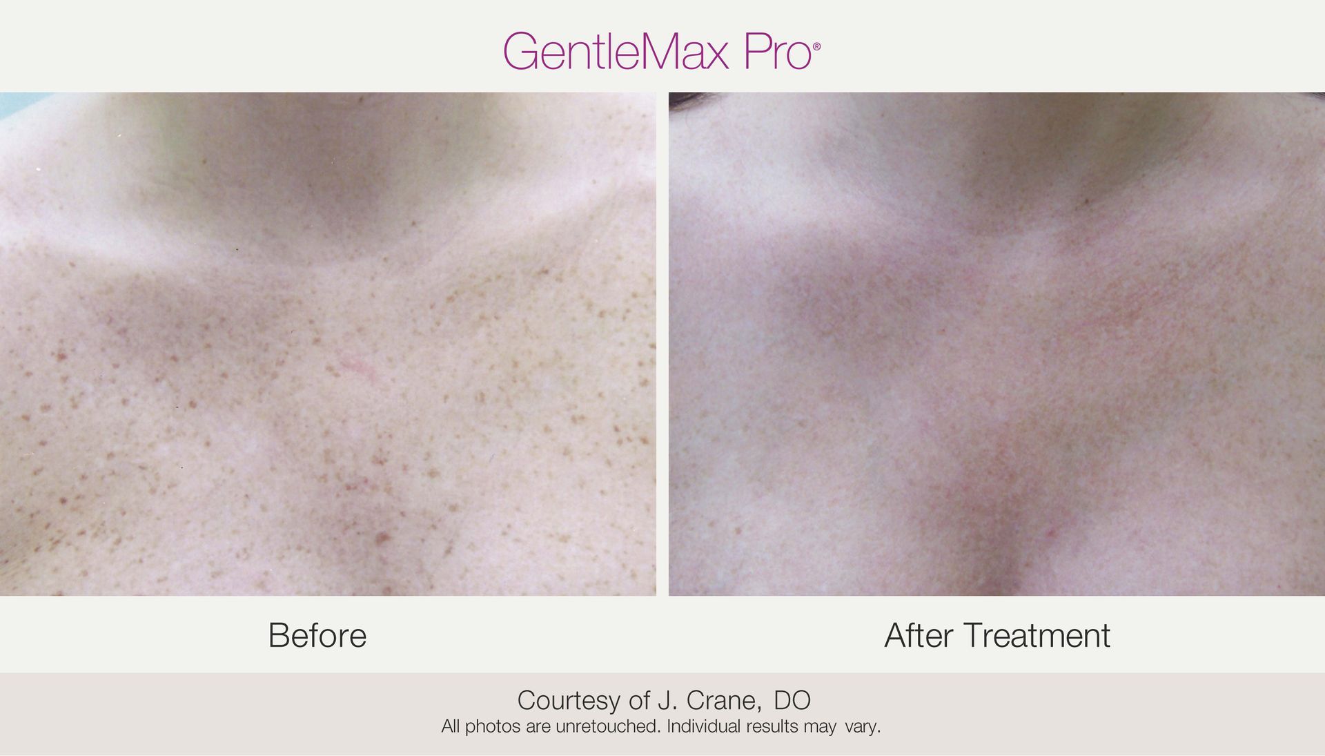 Chest skin before and after GentleMax Pro laser hair removal.
