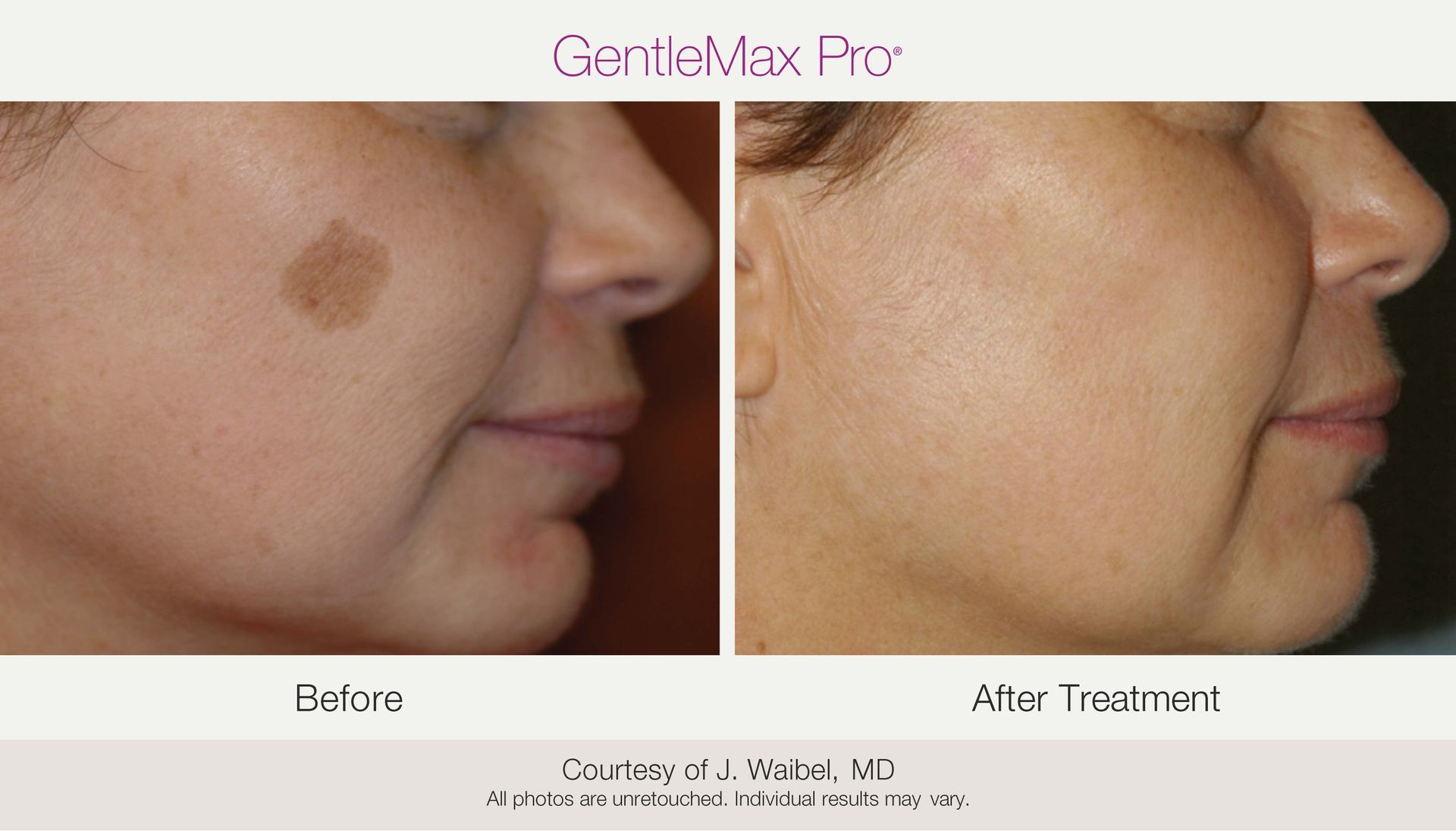 Before-and-after of a woman's face. The left shows a brown spot, and the right shows it removed, after laser treatment.