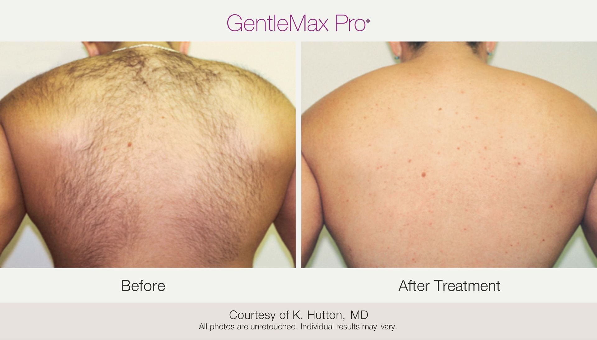 Before and after comparison of a back undergoing hair removal treatment.