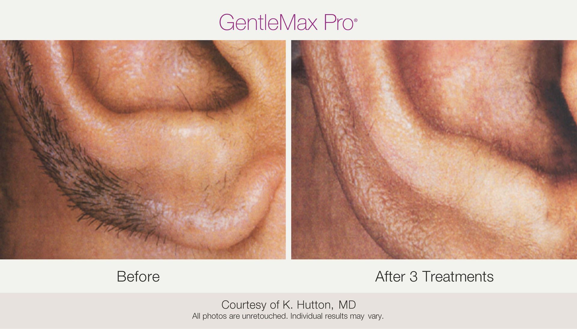 Before and after ear hair removal: before shows dark hairs, after shows significantly reduced hair.