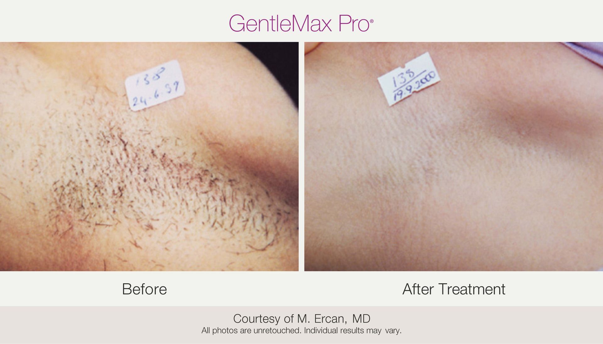 Before-and-after comparison of underarm laser hair removal using the GentleMax Pro device. The 