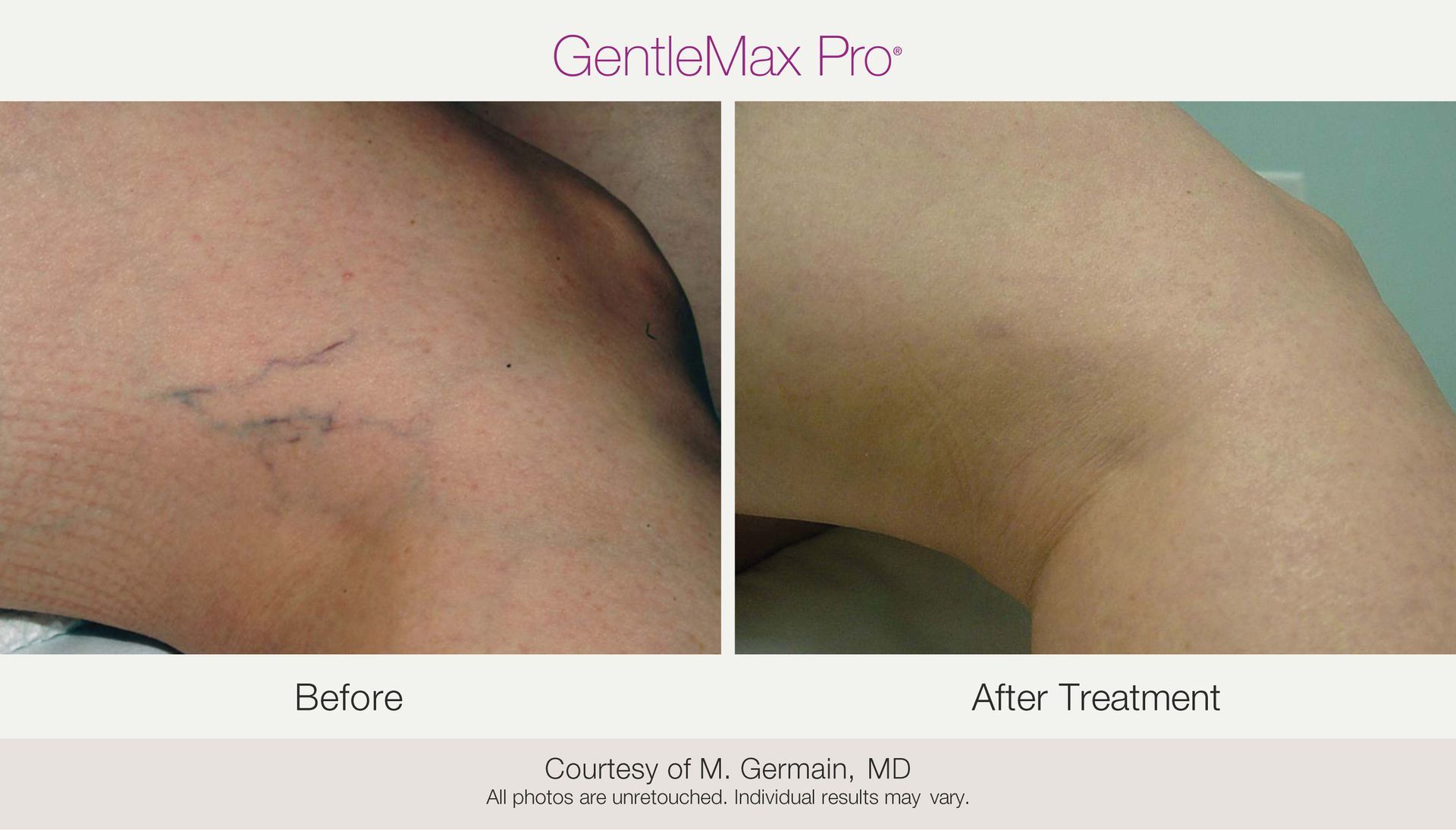 Before-and-after photos of a leg. Before: visible veins. After: veins less visible.