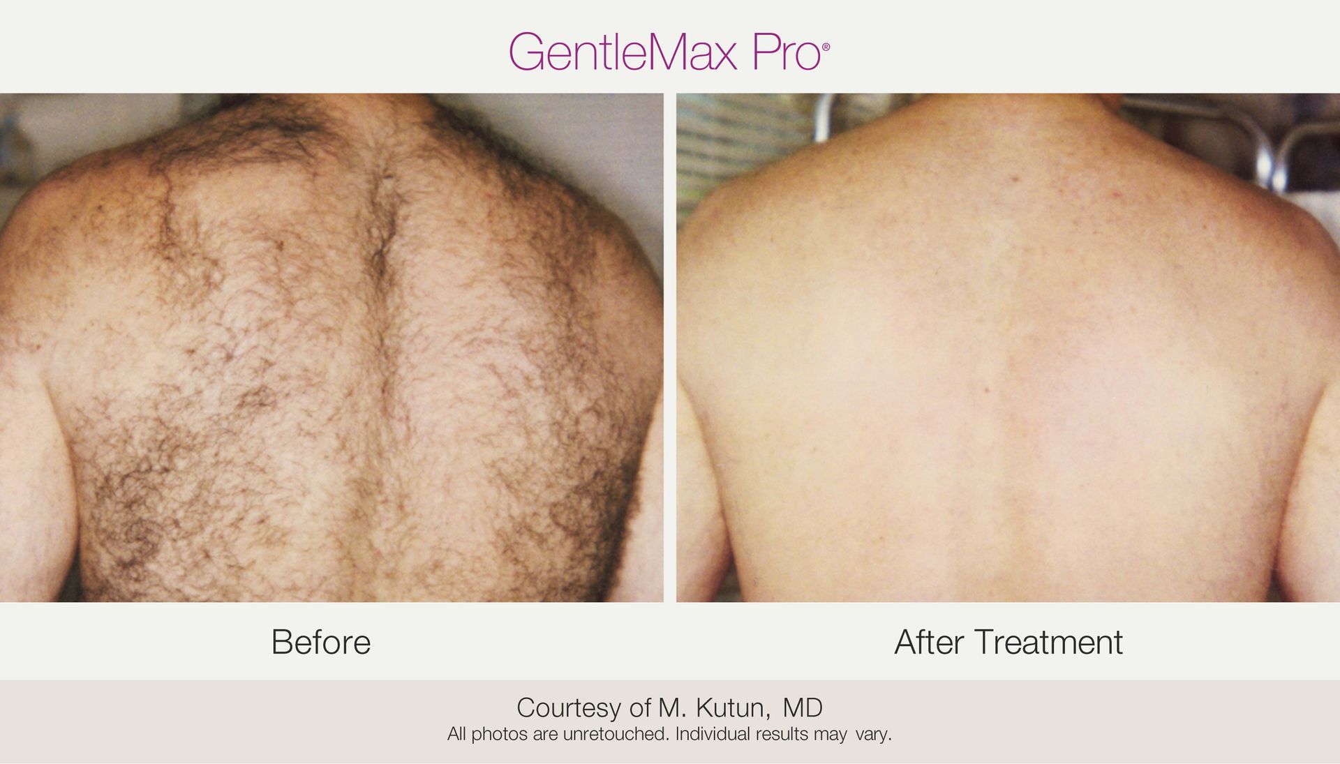 Before and after laser hair removal on a man's back; the 