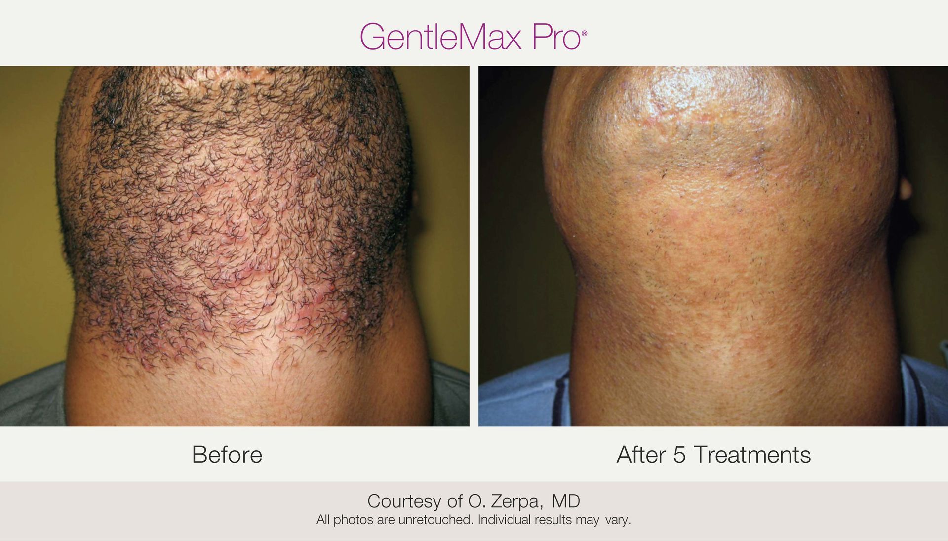 Before/after of laser hair removal on a person's neck. The 