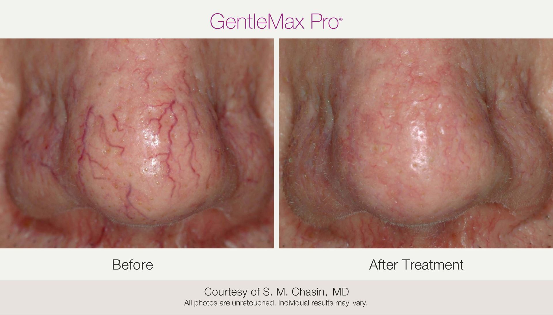 Before and after comparison of a nose with visible blood vessels, then improved after treatment.