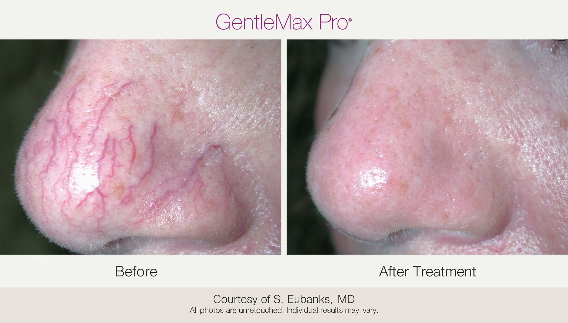 Before and after photos of a nose with visible veins treated with GentleMax Pro laser, showing a reduction in veins.
