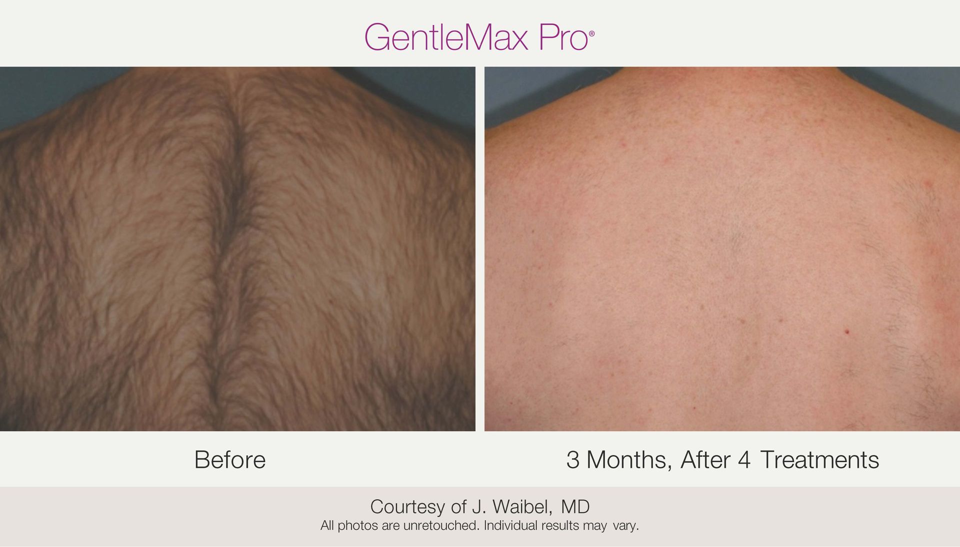 Before and after photos of a man's back, showing hair removal from laser treatments; left shows hairy back, right shows smooth skin.