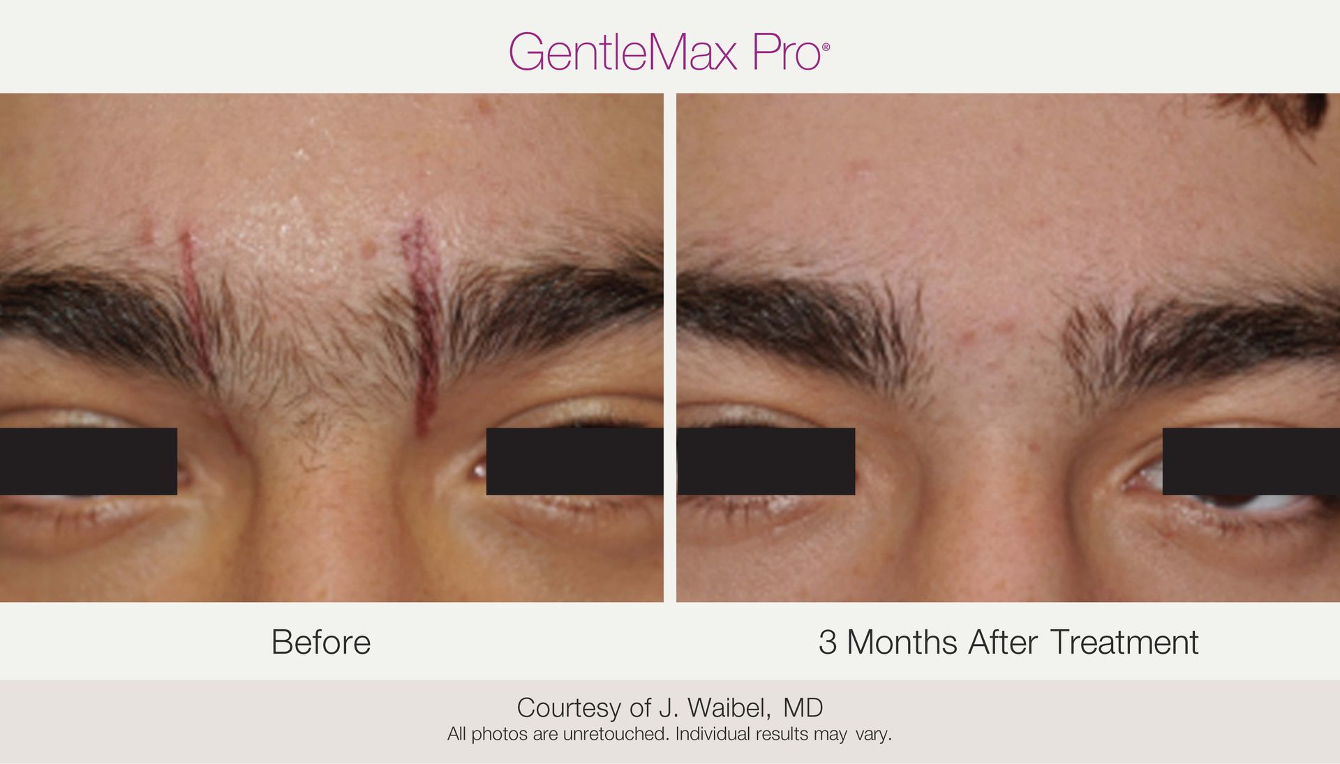 Before-and-after comparison of a man's face. The scar on his forehead fades after 3 months of GentleMax Pro treatment.