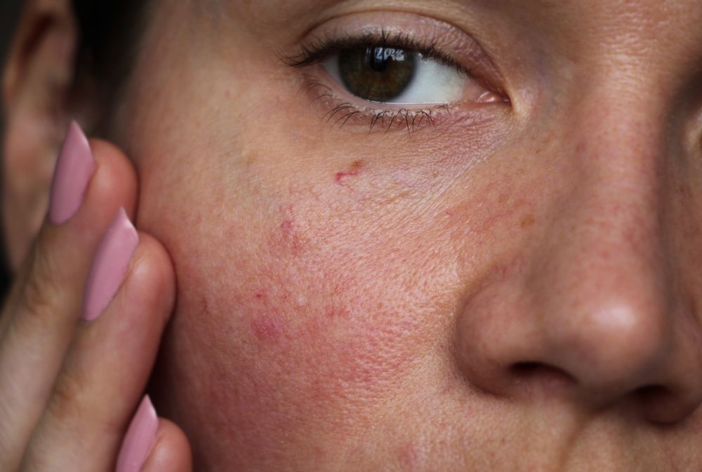 A close up of a woman 's face with red veins.