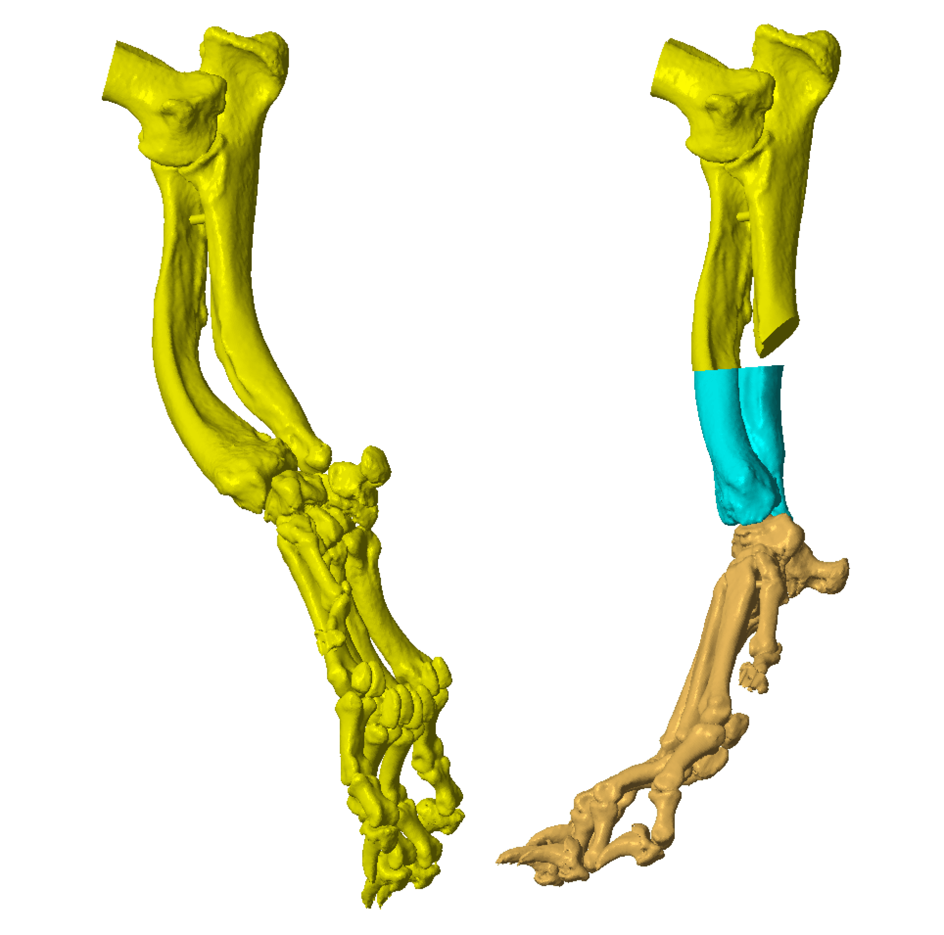 3D Computer Imaging - Angular Limb Growth Deformity