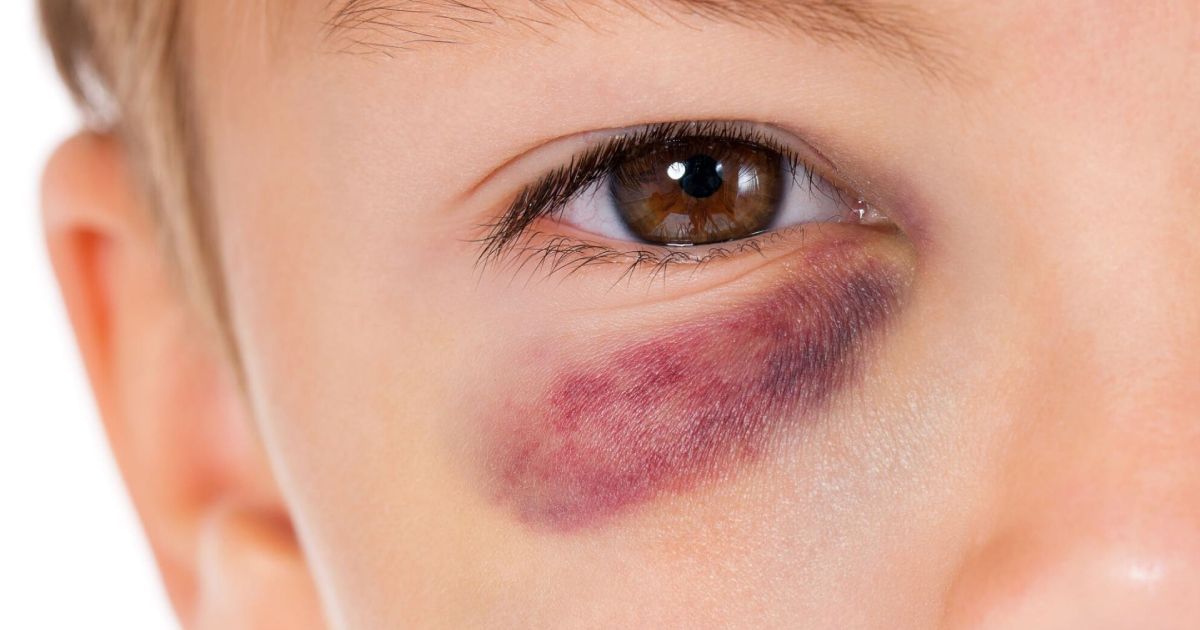 A close up of a child 's eye with a black eye.