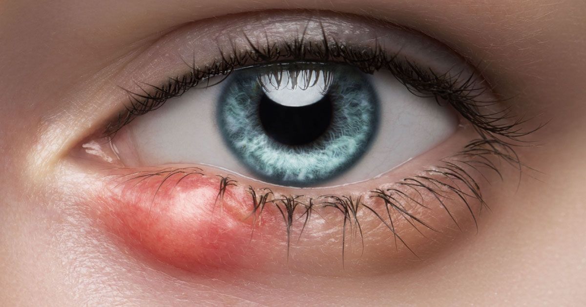 A close up of a woman 's eye with a red swollen bump on her lower eyelid..