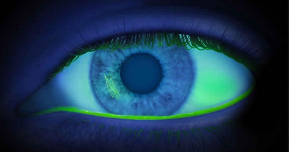 Close-up of an eye with an abrasion, illuminated with ultraviolet light.