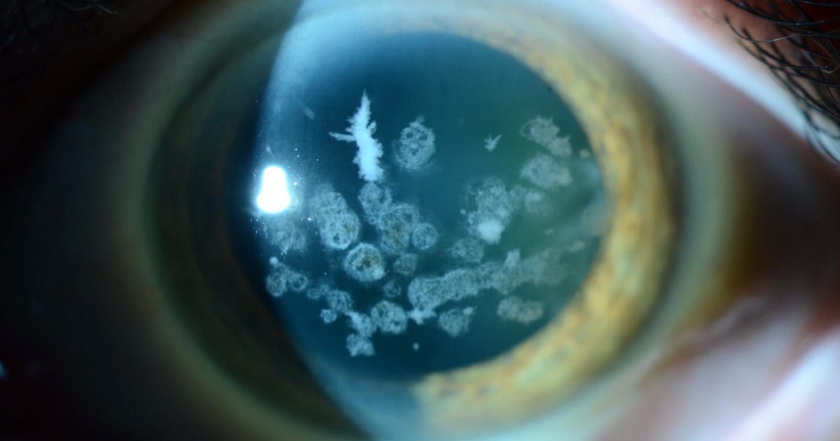 Eye with white, snowflake-like opacities (corneal dystrophy) scattered across the lens.