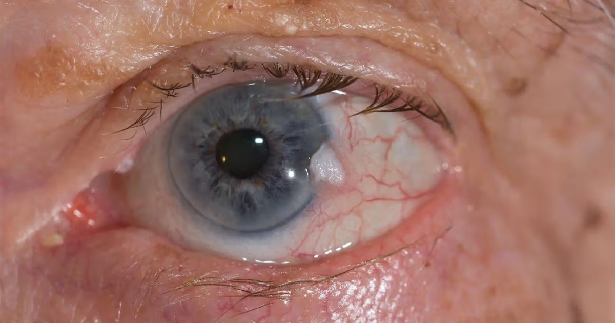 A close up of a person 's eye with a blue pupil showing a cancerous module.