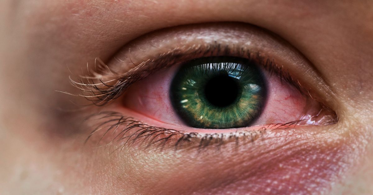 A close up of a person 's eyeball with redness around the iris