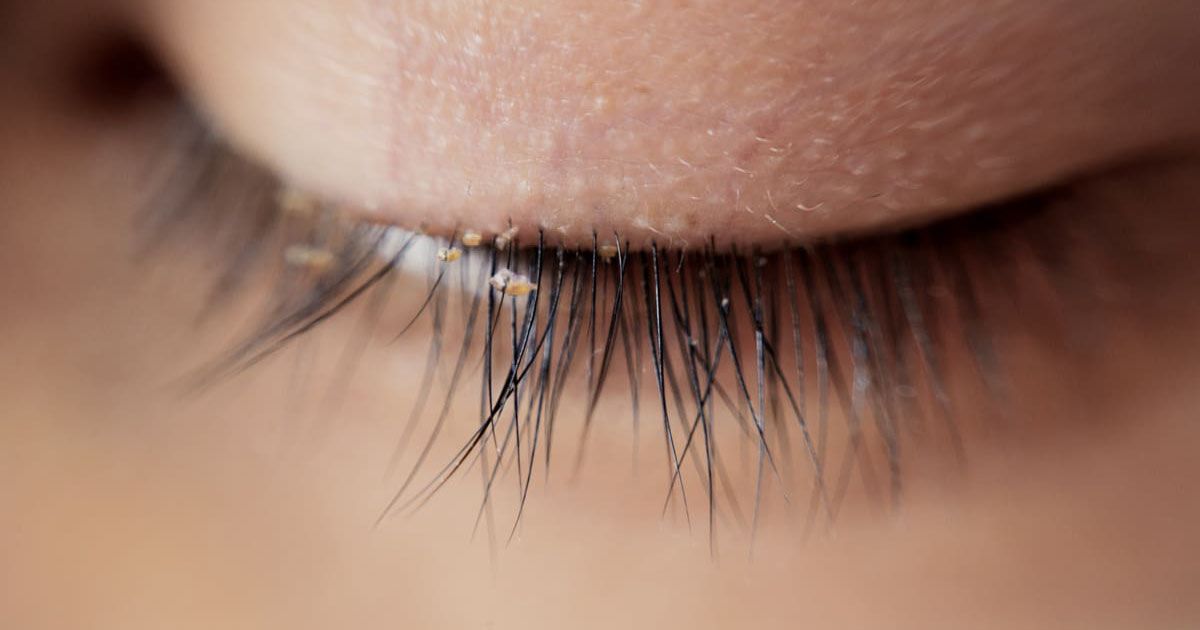 Close-up of a closed eye showing an example of microscopic mites on the eyelashes.