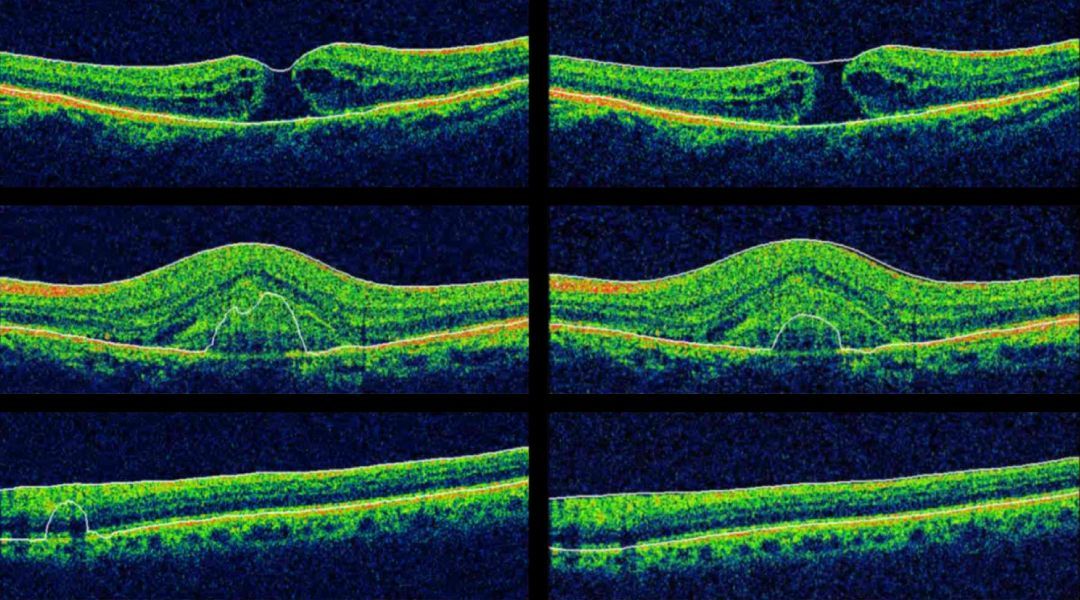 Several scans from an OCT screening showing the layers of the eye