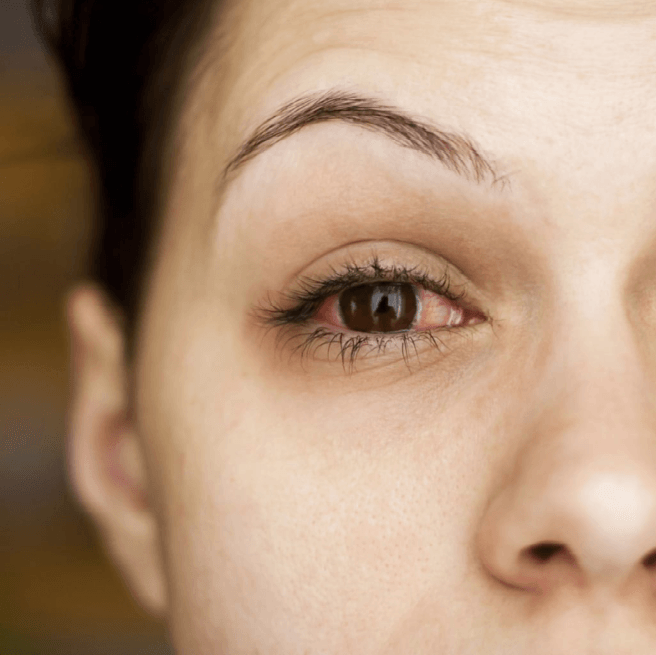 Woman with redness in her right eye