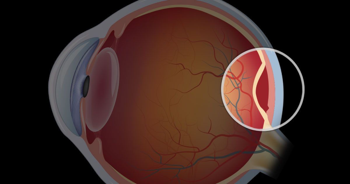A close up of the inside of a human eye showing a retinal detachment