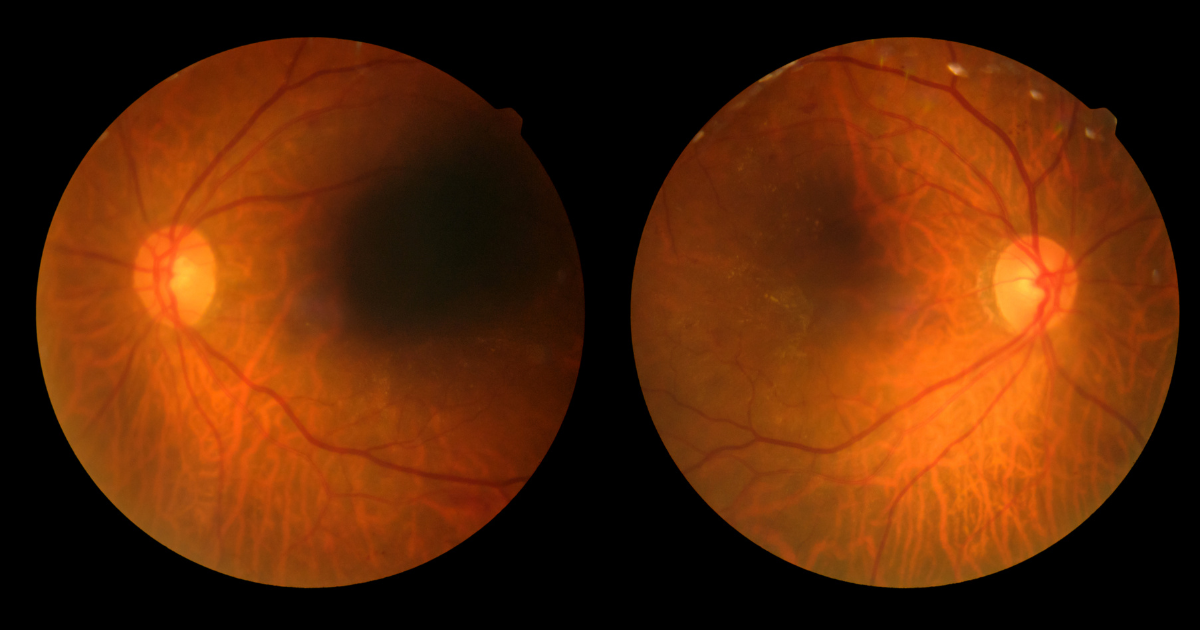 Two eyes with Diabetic Retinopathy