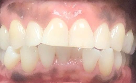 A close up of a person 's teeth and gums.
