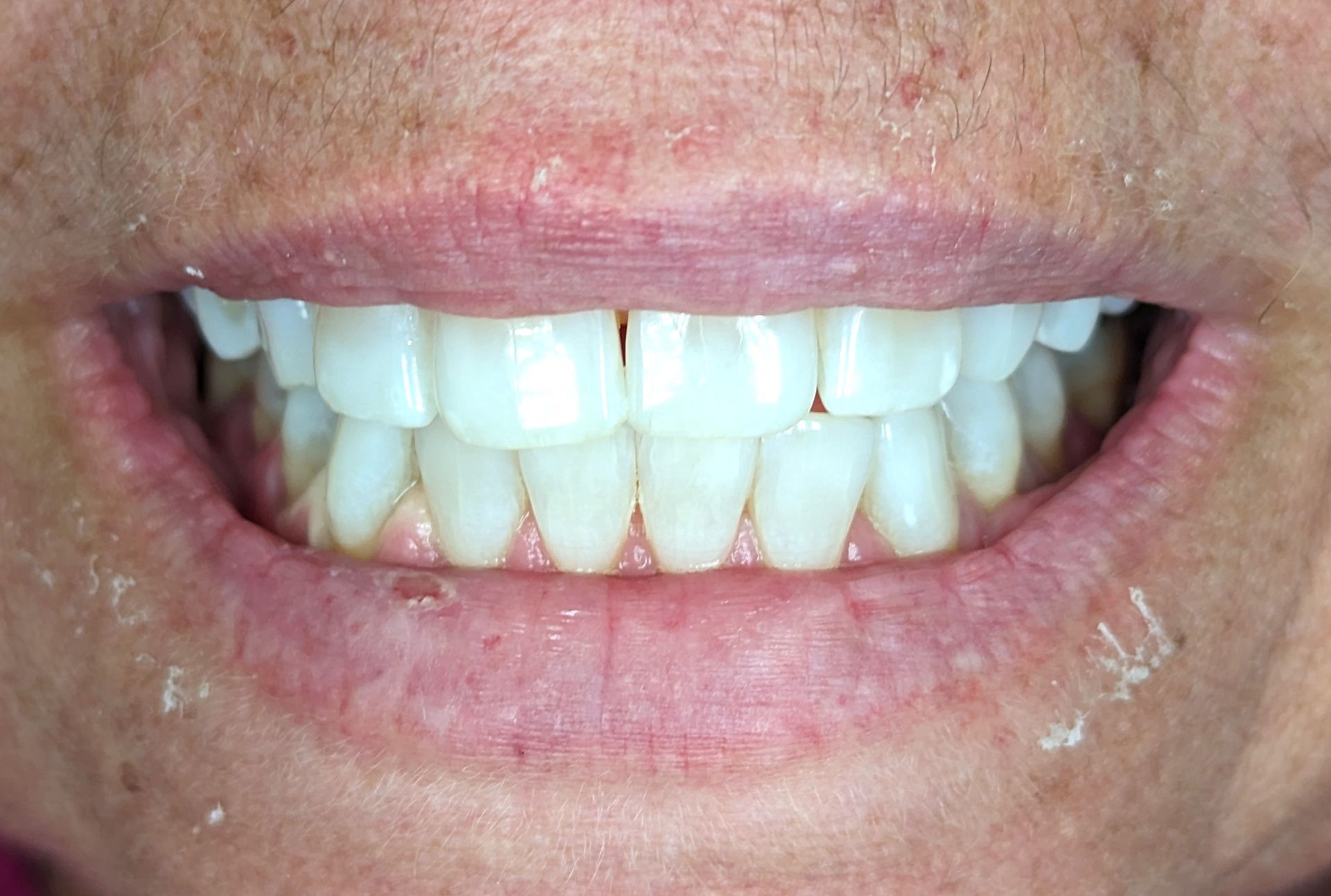 A close up of a person 's mouth with white teeth.