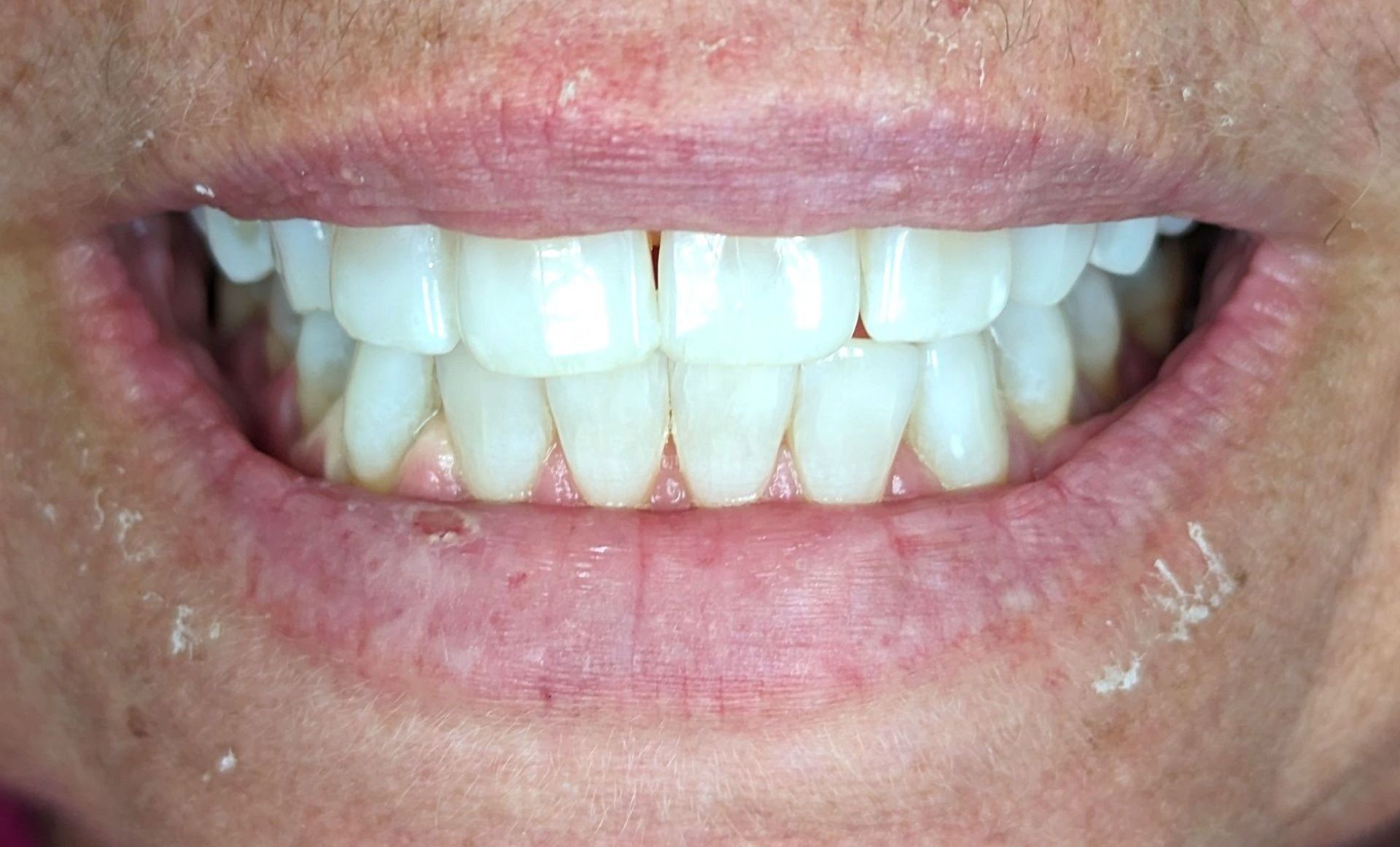 A close up of a person 's mouth with white teeth.