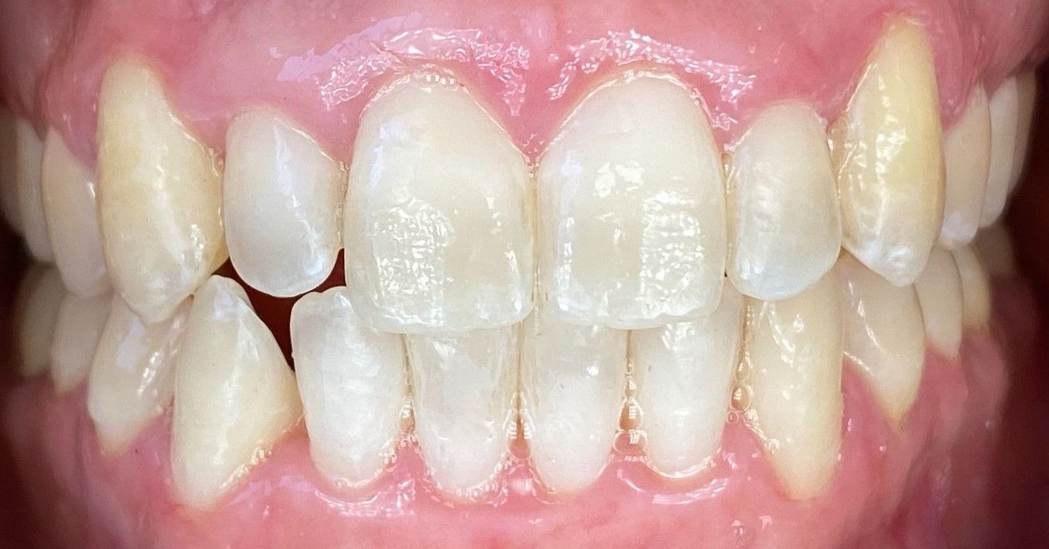 A close up of a person 's teeth with white teeth.