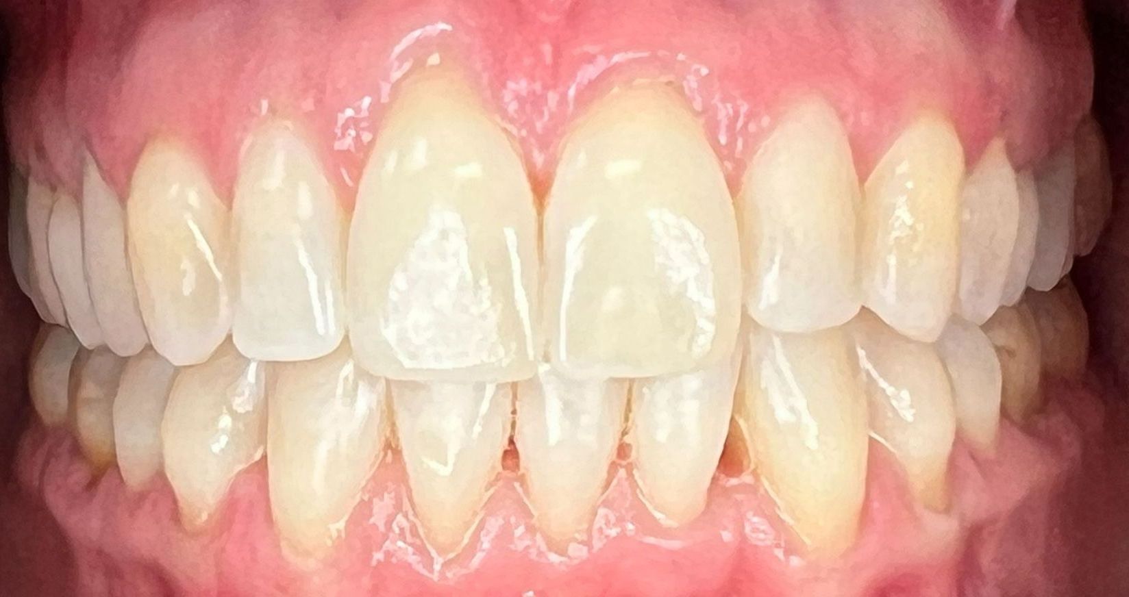 A close up of a person 's teeth with white teeth.