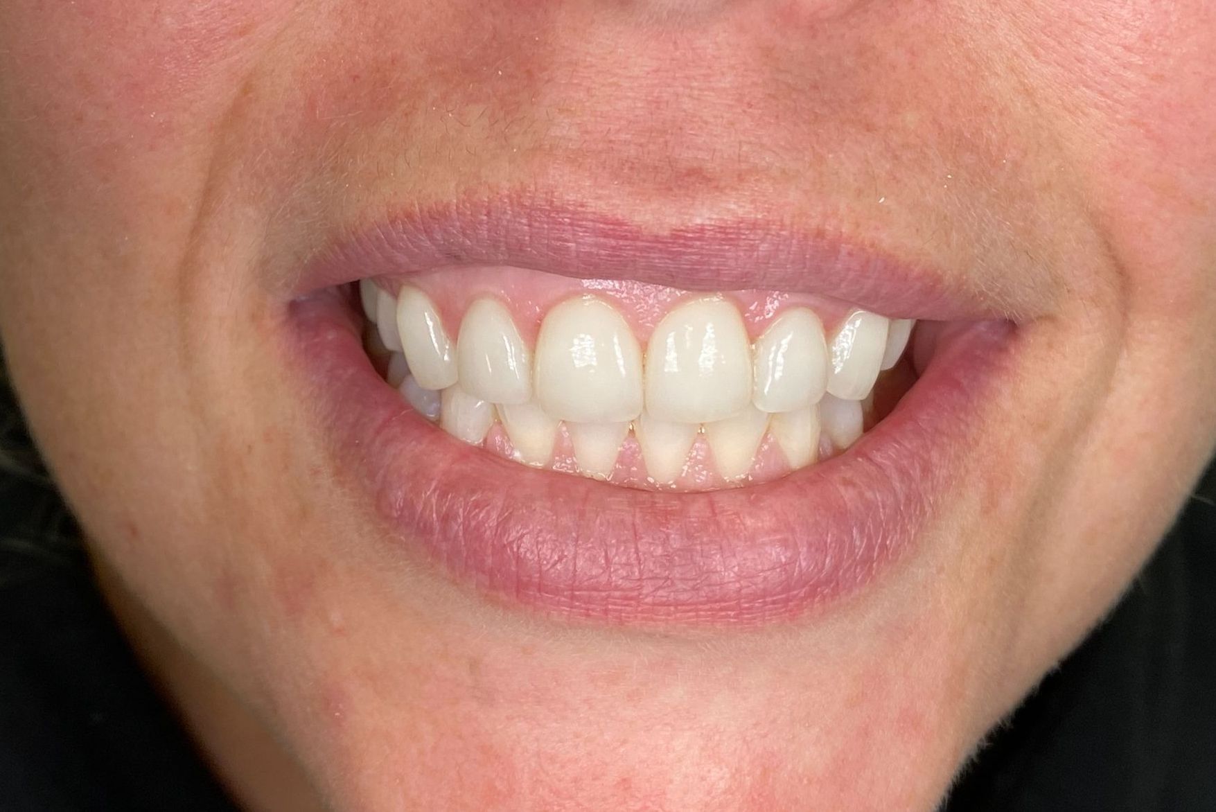 A close up of a woman 's smile with white teeth.