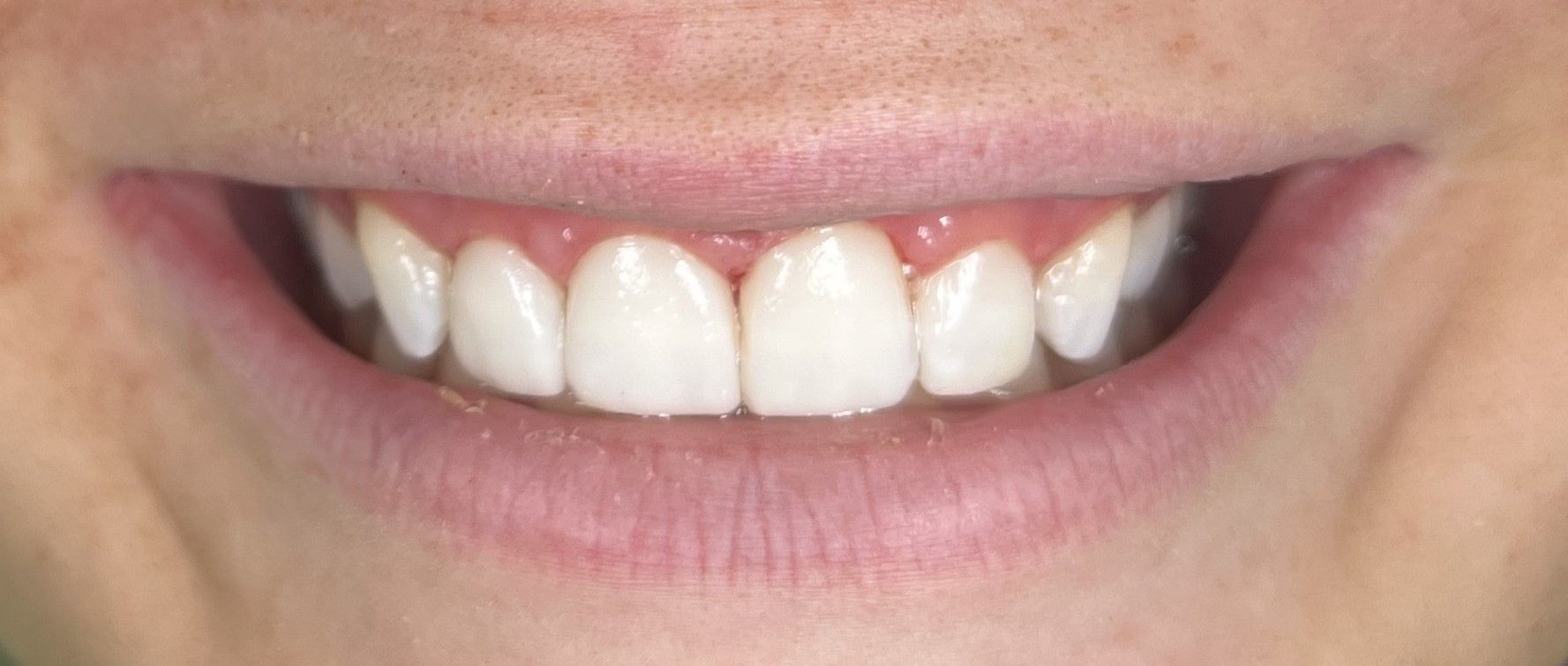 A close up of a person 's smile with white teeth.