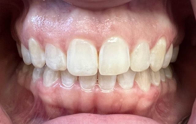 A close up of a person 's teeth with white teeth.